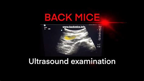 Simple Back Mouse Ultrasound Painful Lump In The Lower Back Youtube