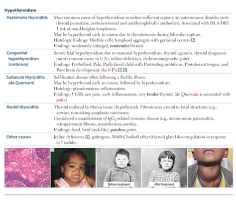 Hypothyroidism Flashcards Quizlet