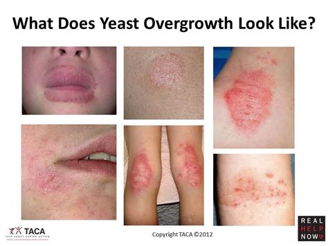 Yeast Overgrowth Candida Overgrowth Yeast Infection Cure