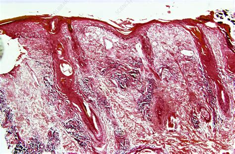 Discoid Lupus Erythematosus Lm Stock Image C0252876 Science