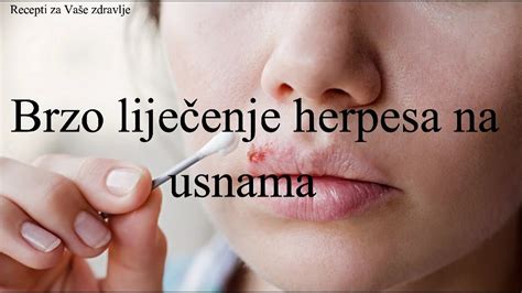 Brzo Liječenje Herpesa Na Usnama Sredstva Narodne Medicine Youtube