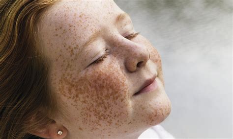 ≡ 8 Things You Never Knew About Freckles Brain Berries