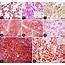 A Skin Canine Mast Cell Tumor Immunohistochemical Staining For 