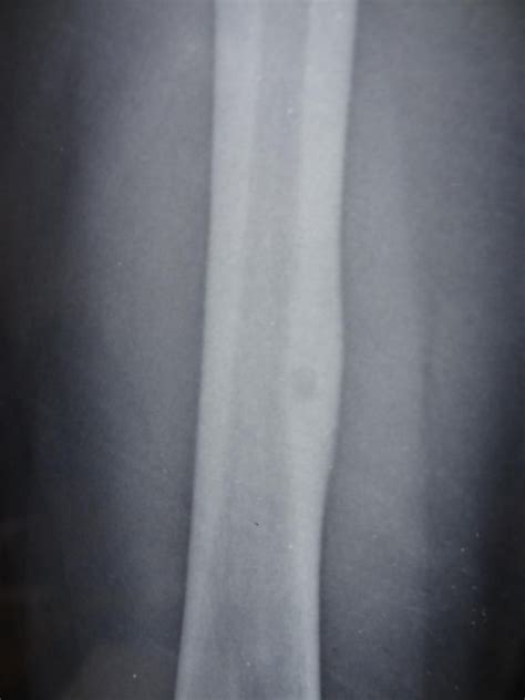 Osteoid Osteoma Radiology Case Radiology Bone