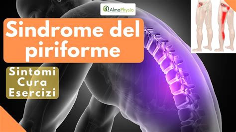 Sindrome Del Piriforme Sintomi Cura Esercizi Almaphysio