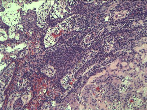 Basaloid Squamous Cell Carcinoma With Peripheral Palisading Download