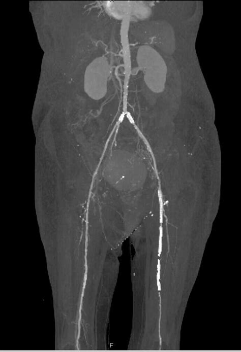 Cta Runoff With Peripheral Vascular Disease And Stents In The Left