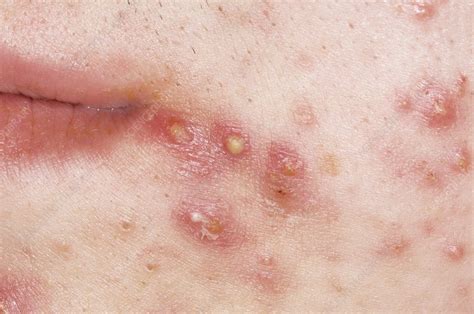 Acne Vulgaris On The Face Stock Image C0090059 Science Photo Library