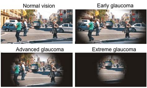 Glaucoma Vision Causes Of Vision Loss Worldwide — м