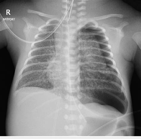 Chest Radiography Revealed Newly Developed Left Sided Pneumothorax