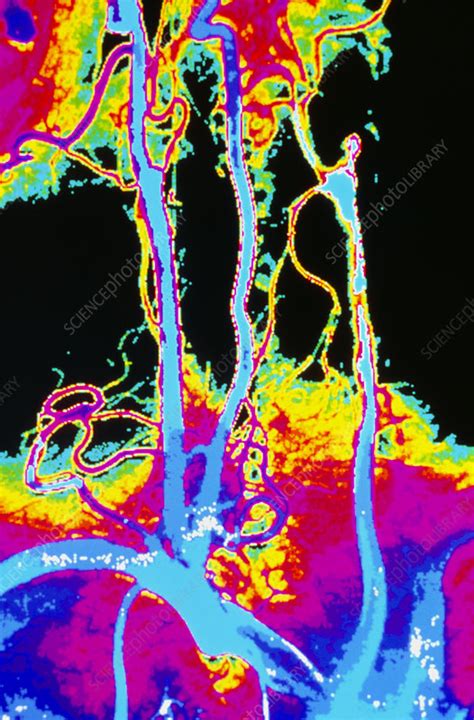 Colour Angiogram Of Arteries In The Human Neck Stock Image P206