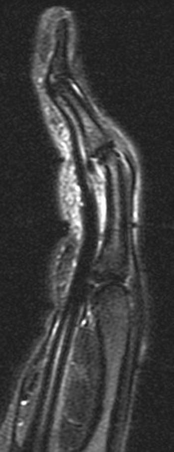 Pulley Lesion Of The Fingers Radsource