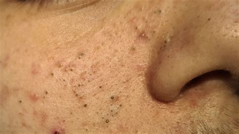 Blackhead Pimpletv The Best Pimple Popping 2023 Videos Youll Find
