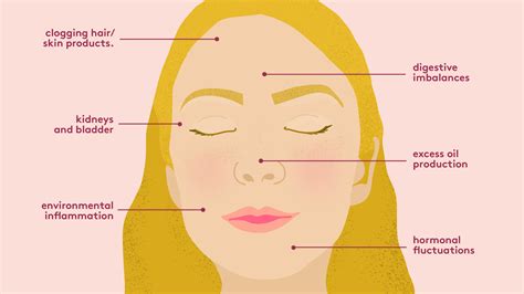Acne Face Mapping What The Breakouts On Your Face Are Telling You