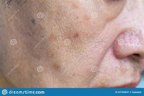 Enlarged Pores In Face Of Asian Elder Man With Skin Folds Stock Image