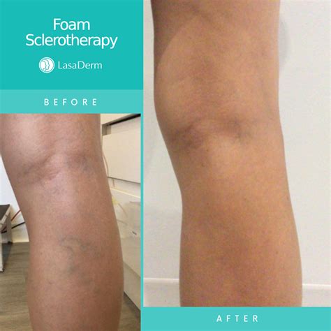 Varicose Vein Removal With Foam Sclerotherapy Lasaderm