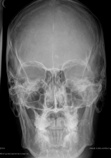 Patients can be imaged either erect or recumbent. Skull PA view | Image | Radiopaedia.org
