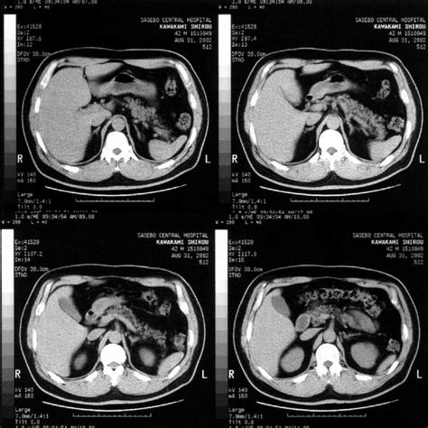 Abdominal Ct Scan Showed Almost Normal Adrenal Glands With Slight