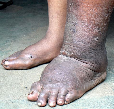 Lymphatic Filariasis Lf Death To Onchocerciasis And Lymphatic