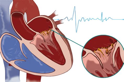 What Should You Know About Infective Endocarditis Corrielus Cardiology