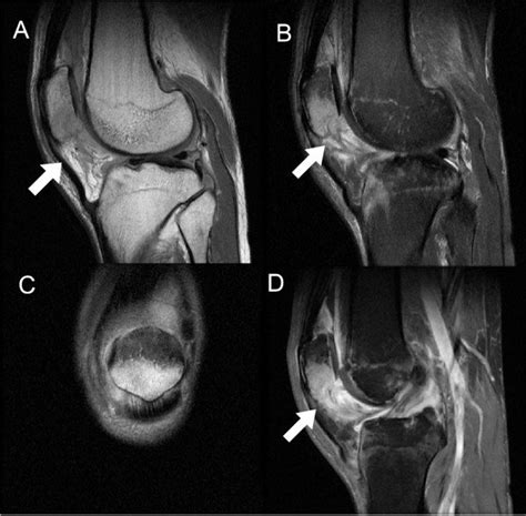 A Contrasted Knee Mri Had Been Performed At An Outside Facility A