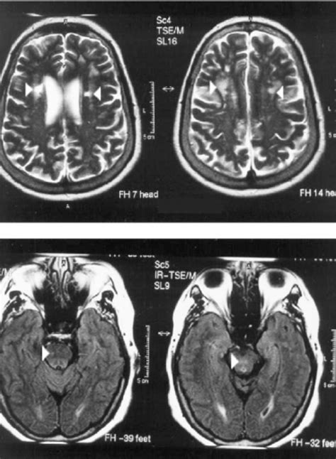 Mri Brain And Brainstem Case 1 Brain Mri Flair And T2 Weighted