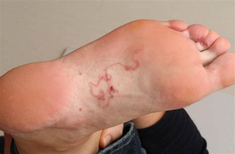 Hookworm Rash Pictures Medical Pictures And Images 2021 Updated