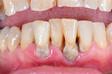 new technique to regrow tissue lost to gum disease bite magazine