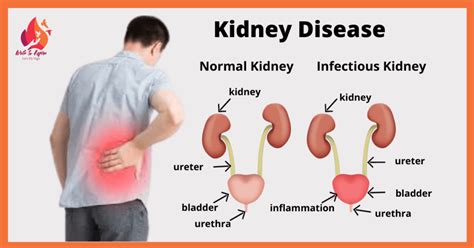 The Kidney Disease Symptoms Causes A Complete Guideline