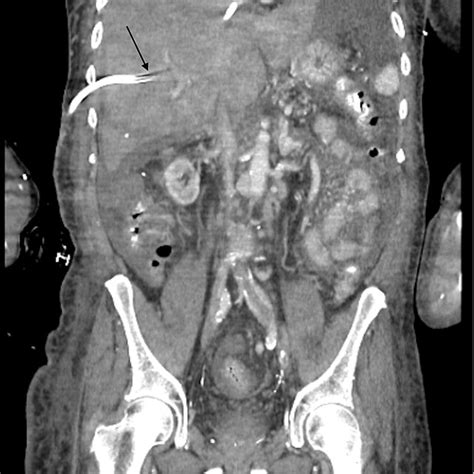 Triple Phase CT Of The Abdomen The Image Shows A Diffusely Enlarged And