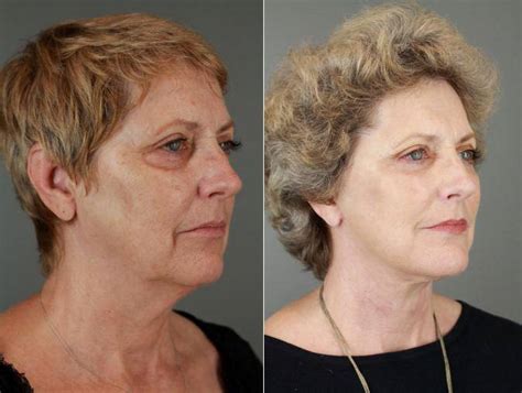66 Year Old Woman Treated With Facelift By Doctor Patti A Flint Md