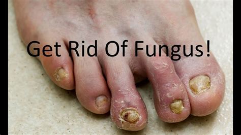 Listerine For Foot And Toenail Fungus Complete Treatment Guide Youtube