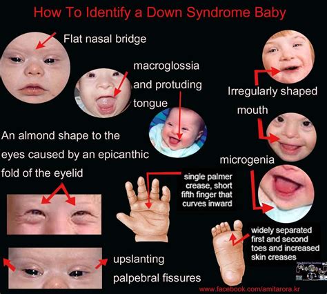 How To Identify A Down Syndrome Baby Nursing Career Nursing Study