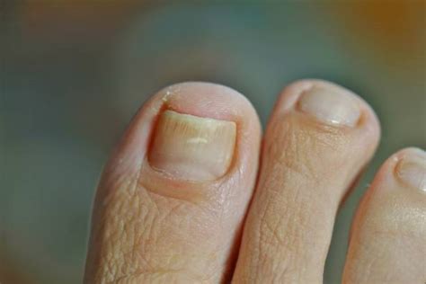 Psoriasis In Toenails Stock Photos Pictures And Royalty Free Images Istock