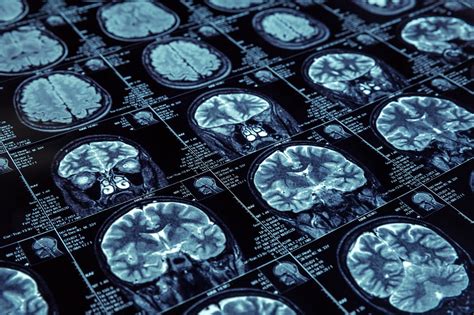 Incidental Findings On Brain Mri For Pediatric Headache