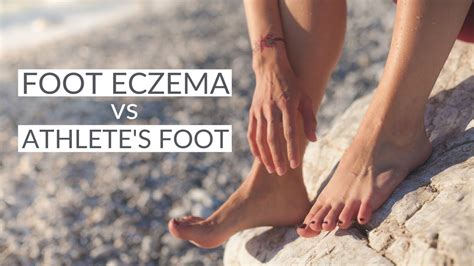 The Difference Between Foot Eczema And Atheletes Foot How To Treat