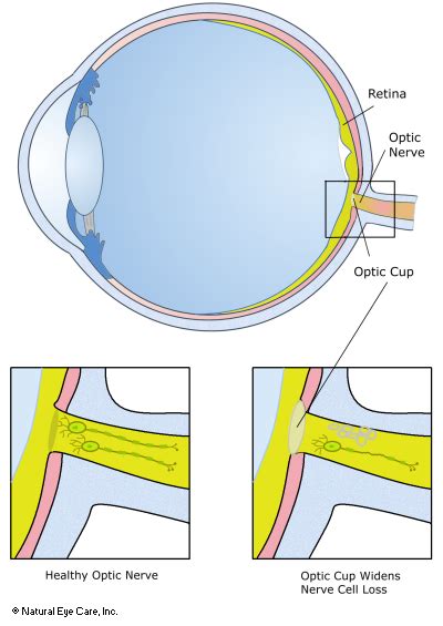 Optic Nerve Atrophy Symptoms And Treatment For Optic Nerve Problems