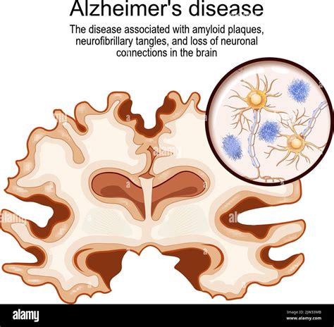 Alzheimers Disease Disease Associated With Amyloid Plaques