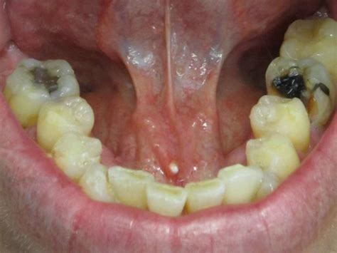 Lingual Tonsil Stones