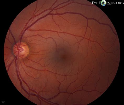 Jan 21, 2018 · glaucoma is one of the most common illnesses affecting the optic nerve. Pigmentary Glaucoma