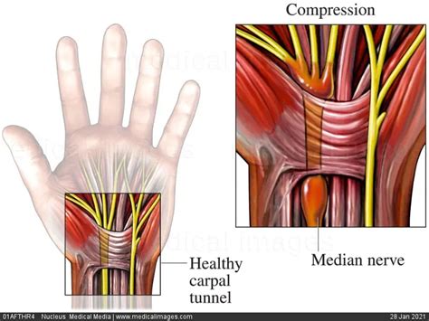 Carpal Tunnel Syndrome Treatment Hand Therapy Brooklyn Ny