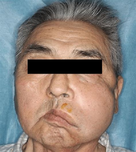 After Sinus Lift Surgery Marked Swelling Is Obvious From The Left