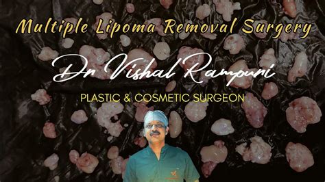 Multiple Lipoma Removal Surgery Youtube