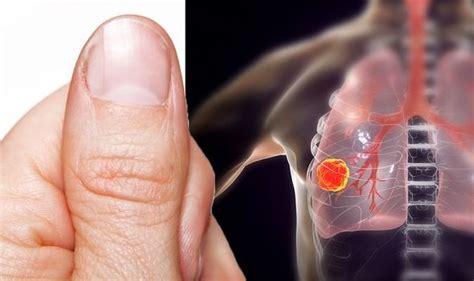 Lung Cancer Symptoms Signs Include Finger Clubbing Uk