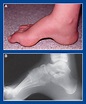 CAVUS - FOOT AND ANKLE DEFORMITIES - Principles and Management of ...