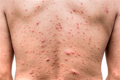 Cystic Acne On Back Causes Treatments Prevention And More Derm