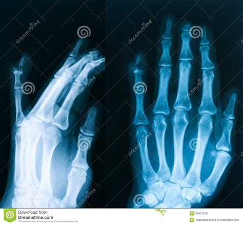 X Ray Image Of Hand Ap And Oblique View Royalty Free Stock Photo