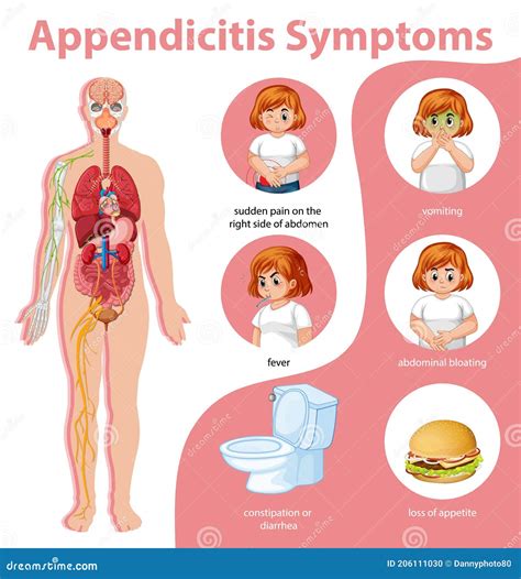 Appendicitis Symptoms Information Infographic Stock Vector