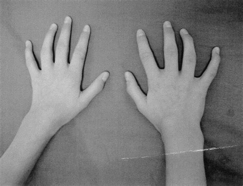 Severe Bilateral Carpal Tunnel Syndrome In Juvenile Chronic Arthritis