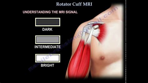 Massive Rotator Cuff Tear Classic Everything You Need To Know Dr My